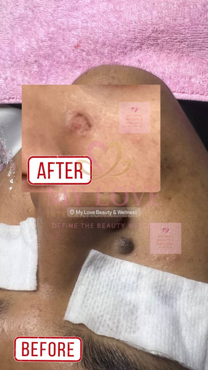 Mole removal before and after