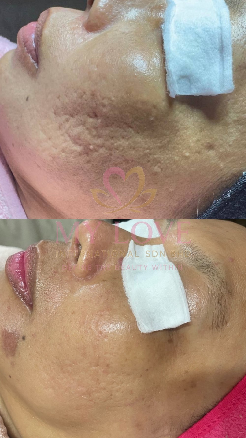 Pigmentation and skin texture treatment before and after