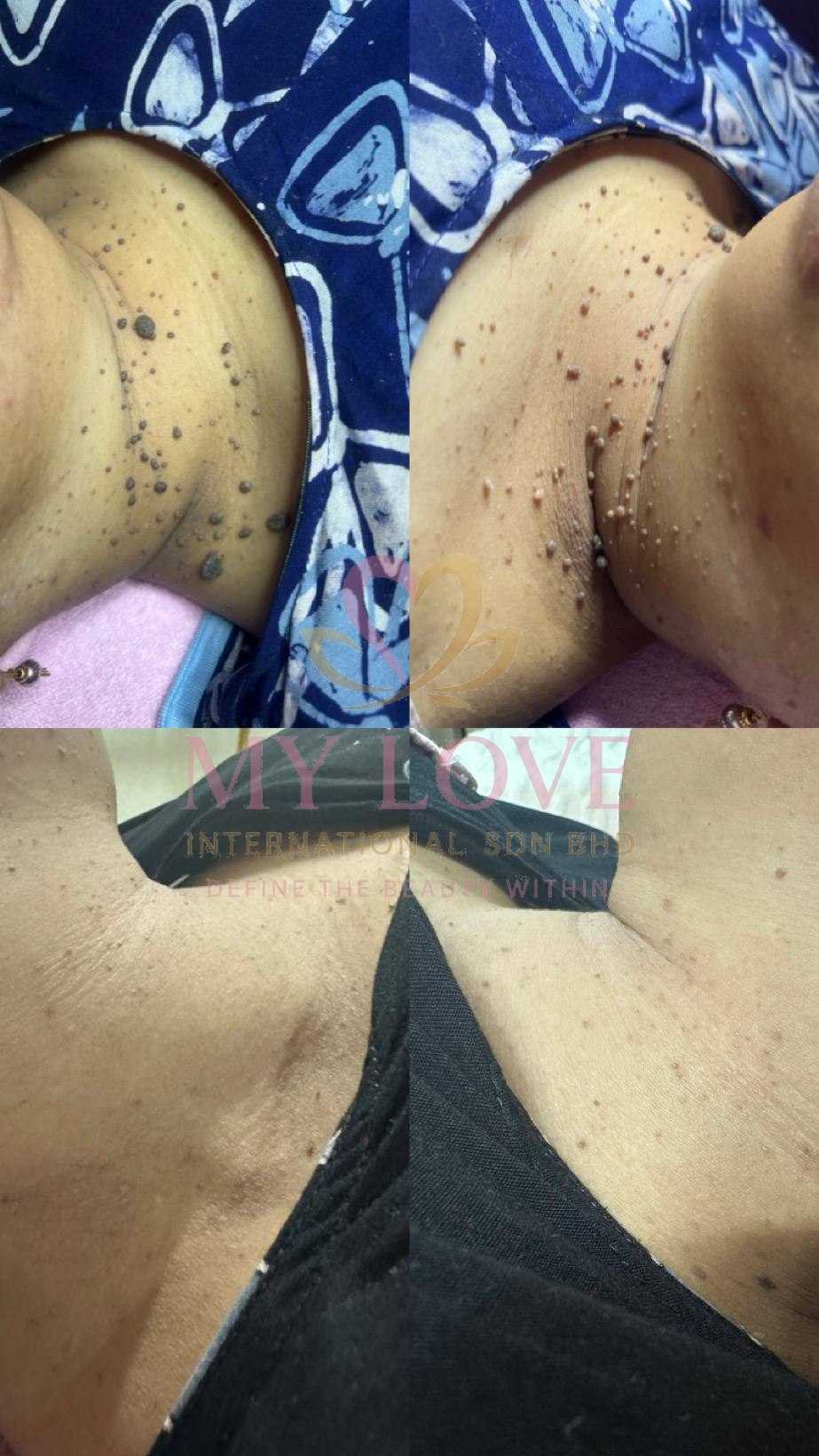 Skin tag removal before and after